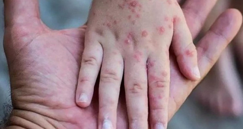Bakan Koca'dan maymun çiçeği virüsü açıklaması